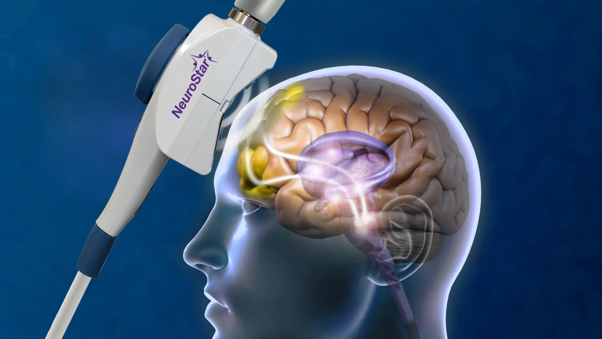 NeuroStar-TMS-Head